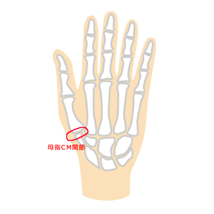 母指CM関節症
