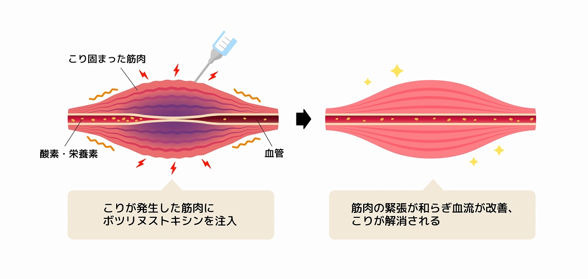 肩こりボトックスについて