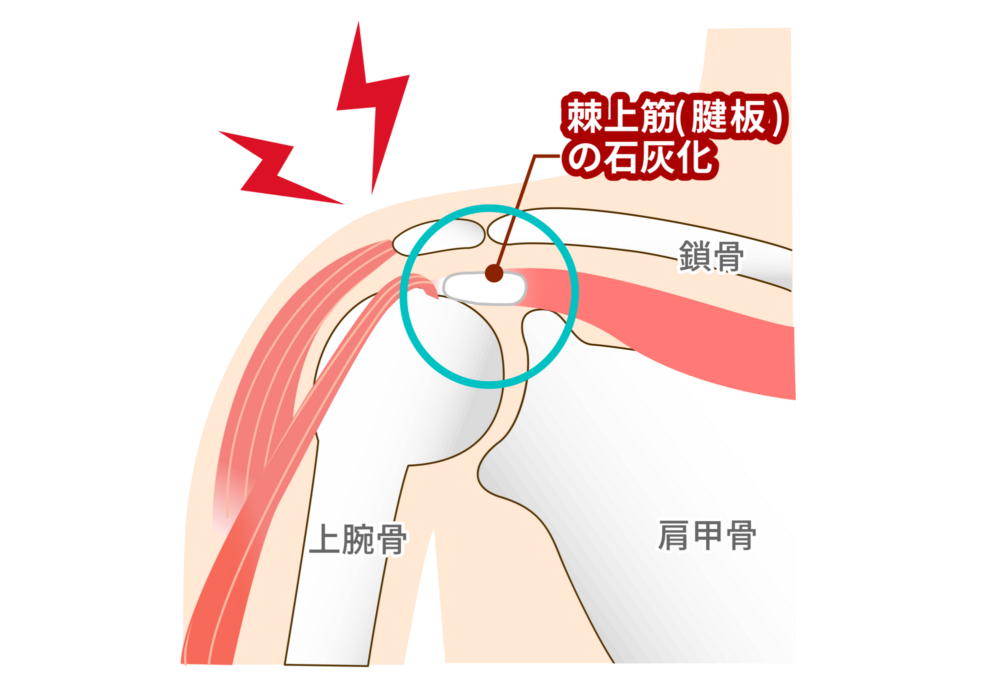 石灰沈着性腱板炎
