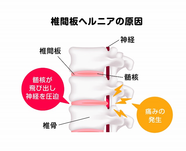 頚椎椎間板ヘルニア