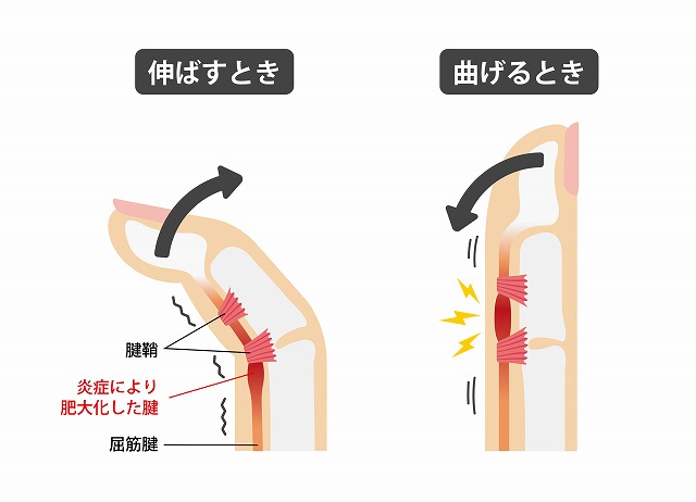 ばね指（腱鞘炎）